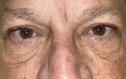 Eyelid Lift (Blepharoplasty/Ptosis Repair)
