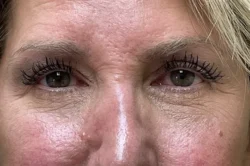 Lower Lid Blepharoplasty (lower eyelid eyelift)