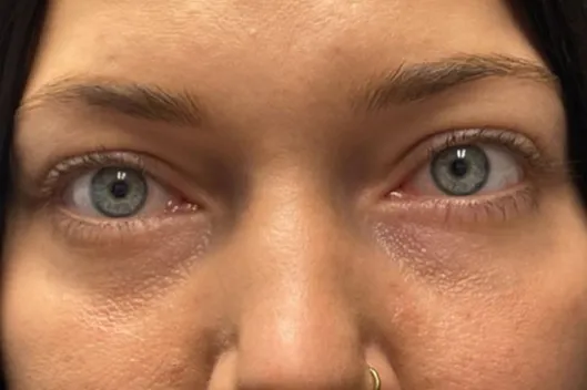 Lower Lid Blepharoplasty (lower eyelid eyelift)