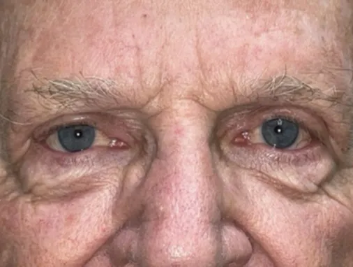 Upper Lid Blepharoplasty (upper eyelid lift)