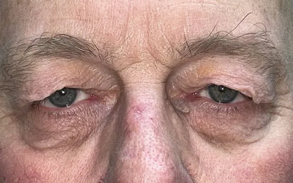 Eyelid Lift (Blepharoplasty/Ptosis Repair)