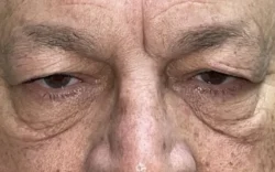 Eyelid Lift (Blepharoplasty/Ptosis Repair)
