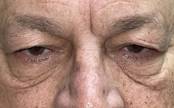 Eyelid Lift (Blepharoplasty/Ptosis Repair)