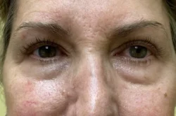 Lower Lid Blepharoplasty (lower eyelid eyelift)