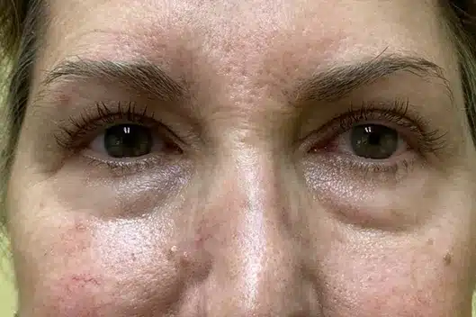 Lower Lid Blepharoplasty (lower eyelid eyelift)
