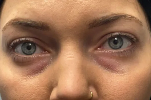 Lower Lid Blepharoplasty (lower eyelid eyelift)