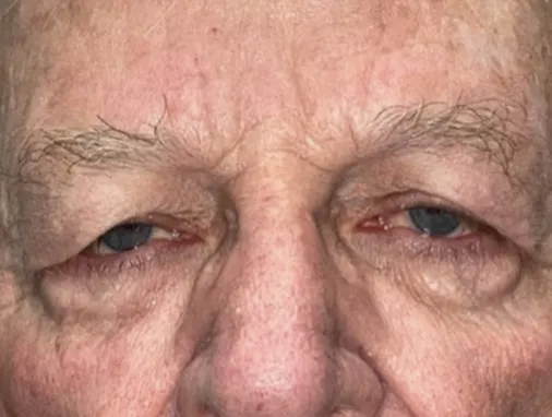 Upper Lid Blepharoplasty (upper eyelid lift)