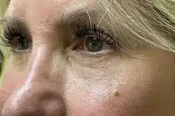 Lower Lid Blepharoplasty (lower eyelid eyelift)