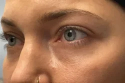 Lower Lid Blepharoplasty (lower eyelid eyelift)