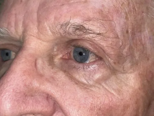 Upper Lid Blepharoplasty (upper eyelid lift)