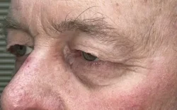 Eyelid Lift (Blepharoplasty/Ptosis Repair)