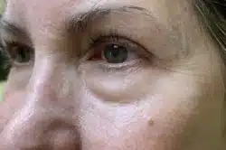 Lower Lid Blepharoplasty (lower eyelid eyelift)