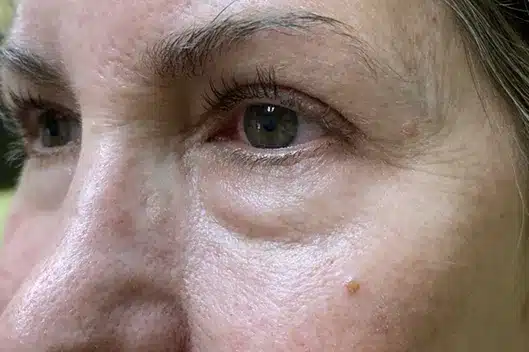Lower Lid Blepharoplasty (lower eyelid eyelift)