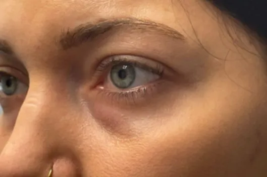 Lower Lid Blepharoplasty (lower eyelid eyelift)