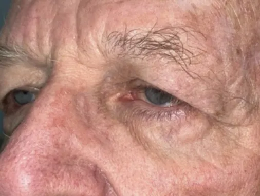 Upper Lid Blepharoplasty (upper eyelid lift)