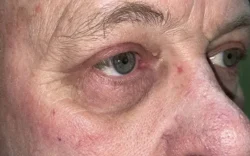 Eyelid Lift (Blepharoplasty/Ptosis Repair)