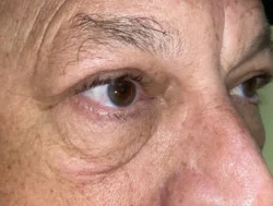 Eyelid Lift (Blepharoplasty/Ptosis Repair)