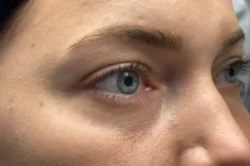 Lower Lid Blepharoplasty (lower eyelid eyelift)