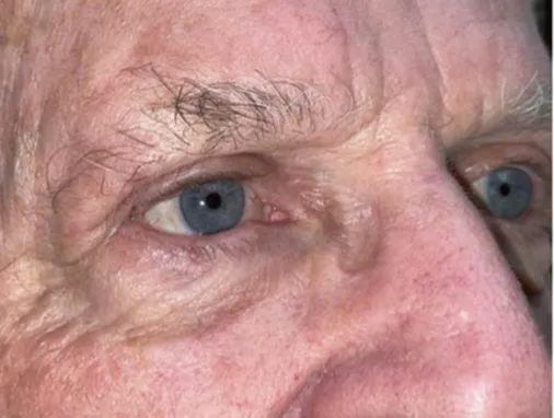 Upper Lid Blepharoplasty (upper eyelid lift)