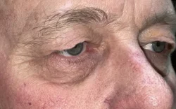 Eyelid Lift (Blepharoplasty/Ptosis Repair)