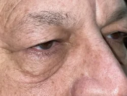 Eyelid Lift (Blepharoplasty/Ptosis Repair)