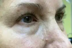 Lower Lid Blepharoplasty (lower eyelid eyelift)