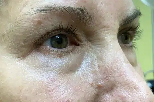 Lower Lid Blepharoplasty (lower eyelid eyelift)