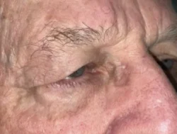 Upper Lid Blepharoplasty (upper eyelid lift)
