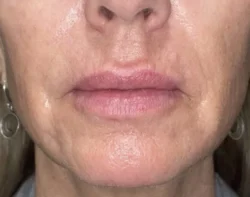 CO2 Laser Resurfacing (wrinkle/line reduction)