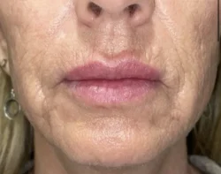 CO2 Laser Resurfacing (wrinkle/line reduction)