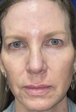 CO2 Laser Resurfacing (wrinkle/line reduction)