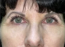 Combination Surgeries (eyelid lift and other)