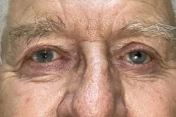 Lower Lid Blepharoplasty (lower eyelid eyelift)