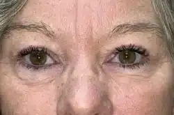 Upper Lid Blepharoplasty (upper eyelid lift)