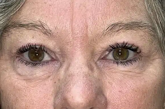 Upper Lid Blepharoplasty (upper eyelid lift)