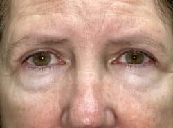 Upper Lid Blepharoplasty (upper eyelid lift)