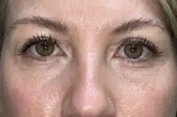Upper Lid Blepharoplasty (upper eyelid lift)