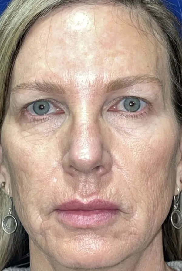 CO2 Laser Resurfacing (wrinkle/line reduction)