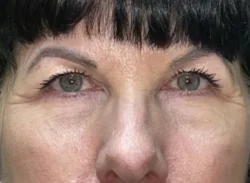 Combination Surgeries (eyelid lift and other)