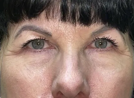Combination Surgeries (eyelid lift and other)
