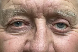 Lower Lid Blepharoplasty (lower eyelid eyelift)