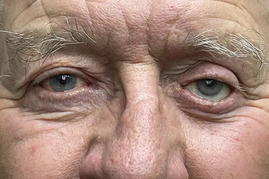 Lower Lid Blepharoplasty (lower eyelid eyelift)