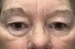 Upper Lid Blepharoplasty (upper eyelid lift)