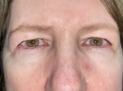 Upper Lid Blepharoplasty (upper eyelid lift)