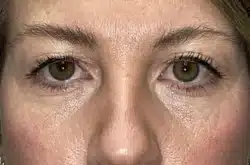 Upper Lid Blepharoplasty (upper eyelid lift)