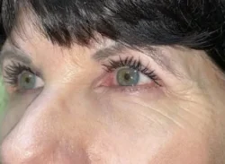 Combination Surgeries (eyelid lift and other)