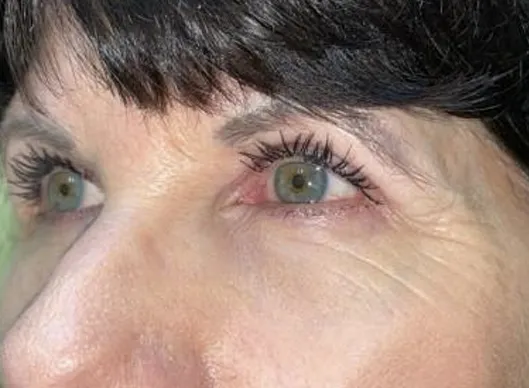 Combination Surgeries (eyelid lift and other)