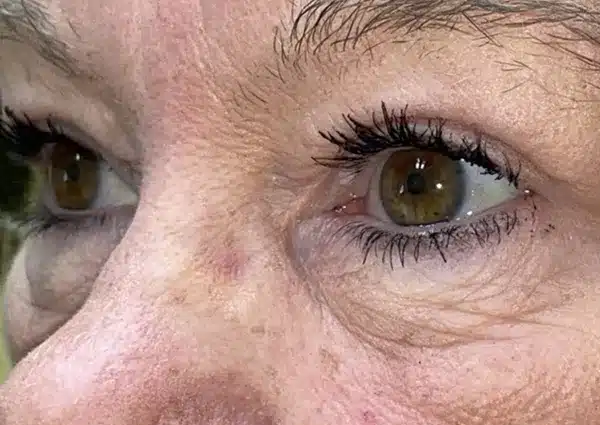 Upper Lid Blepharoplasty (upper eyelid lift)