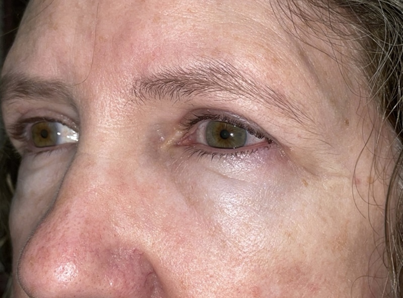 Upper Lid Blepharoplasty (upper eyelid lift)