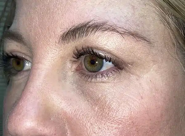 Upper Lid Blepharoplasty (upper eyelid lift)
